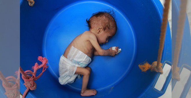 Child malnutrition surges in war-torn Yemen: UN