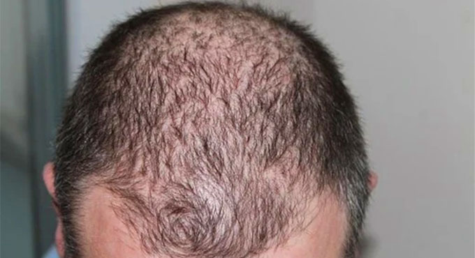 Gene linked to balding may up Covid severity in men