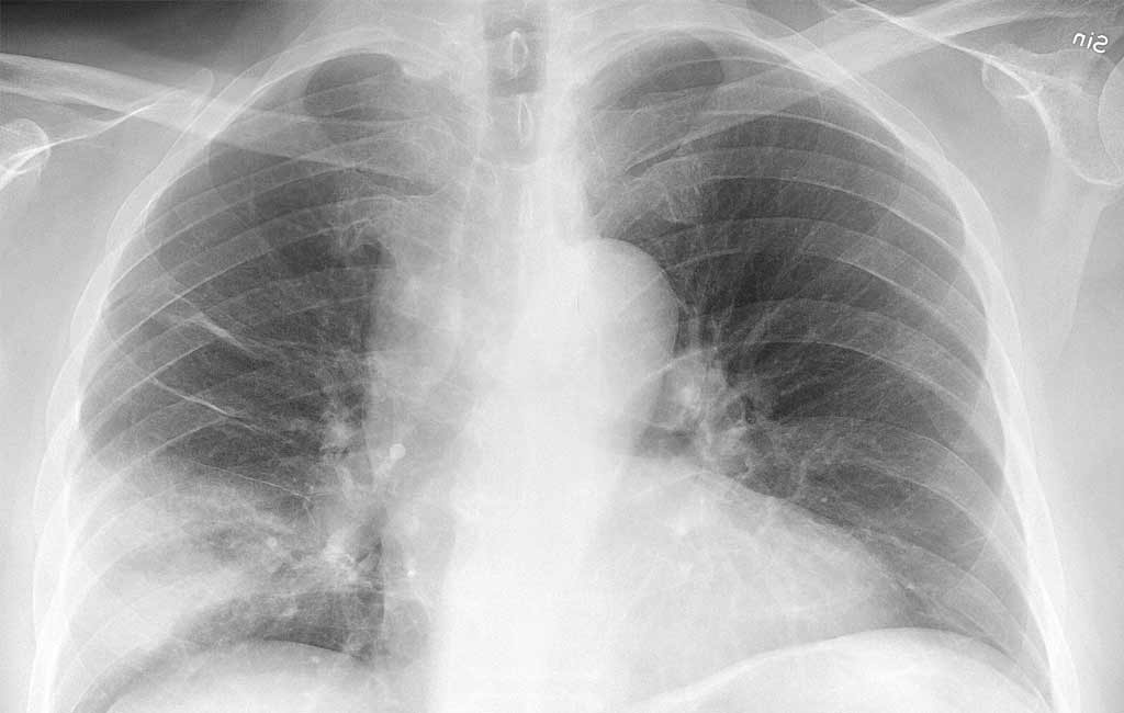 Study finds how lung disease develops long after virus has been cleared