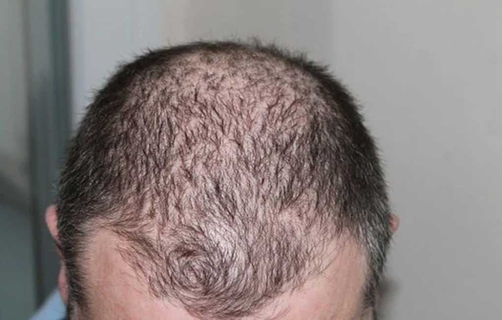 Can Biotin help post-Covid Hair Loss? - Telangana Today