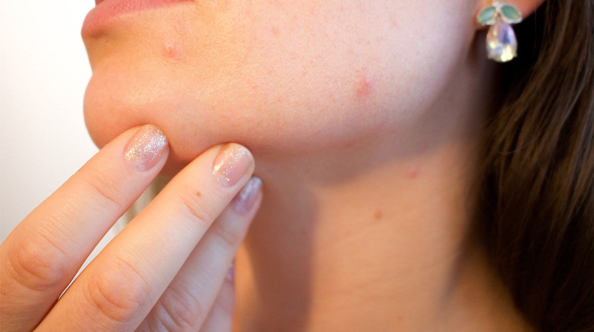 Not all acne is equal! Scientists reveal strains of acnes that promote skin health