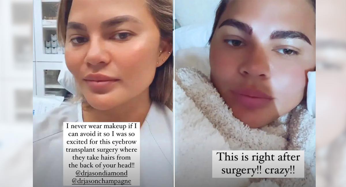 Chrissy Teigen gets slammed online for posting about eyebrow transplants