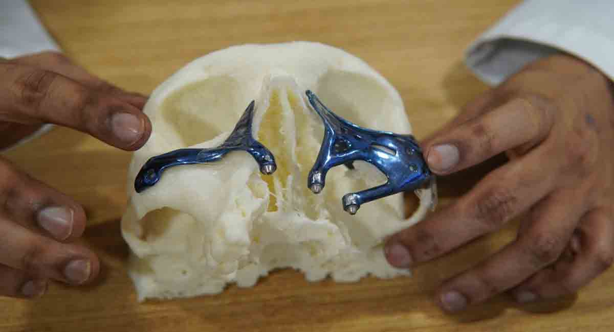 Jaw bone reconstructed for 2 black fungus patients in Hyderabad