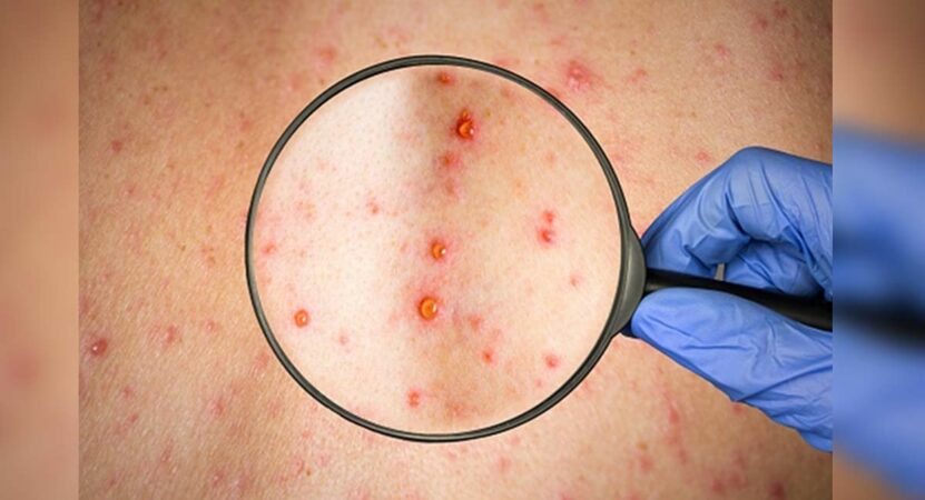 Netherlands confirms first monkeypox case