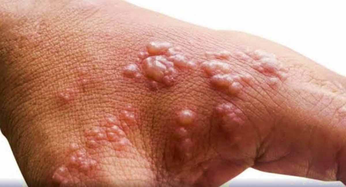 Monkeypox hits Europe, Americas hardest: WHO