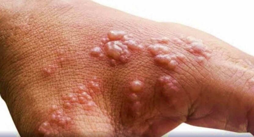 Second monkeypox case in India reported from Kerala