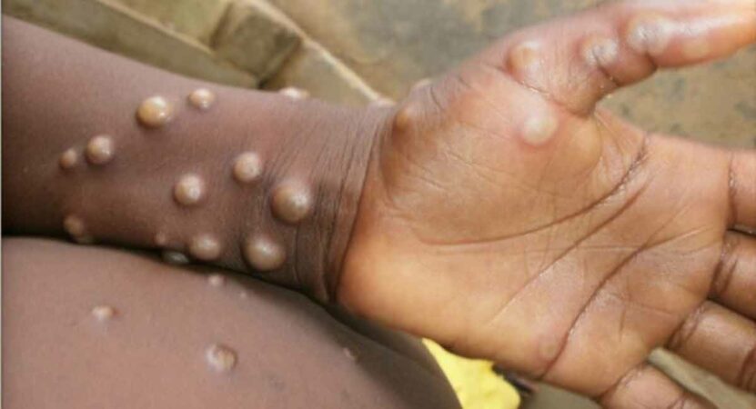 Spain reports 2nd death from monkeypox