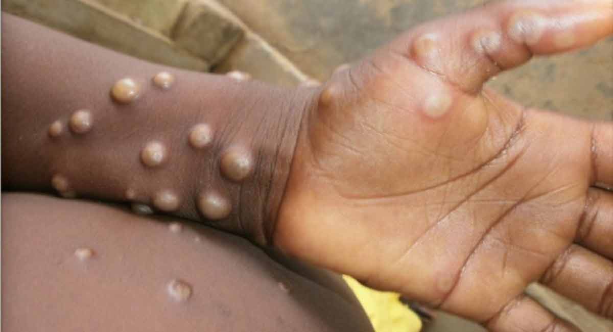 Lack of treatment guidelines hampering monkeypox care globally: Study