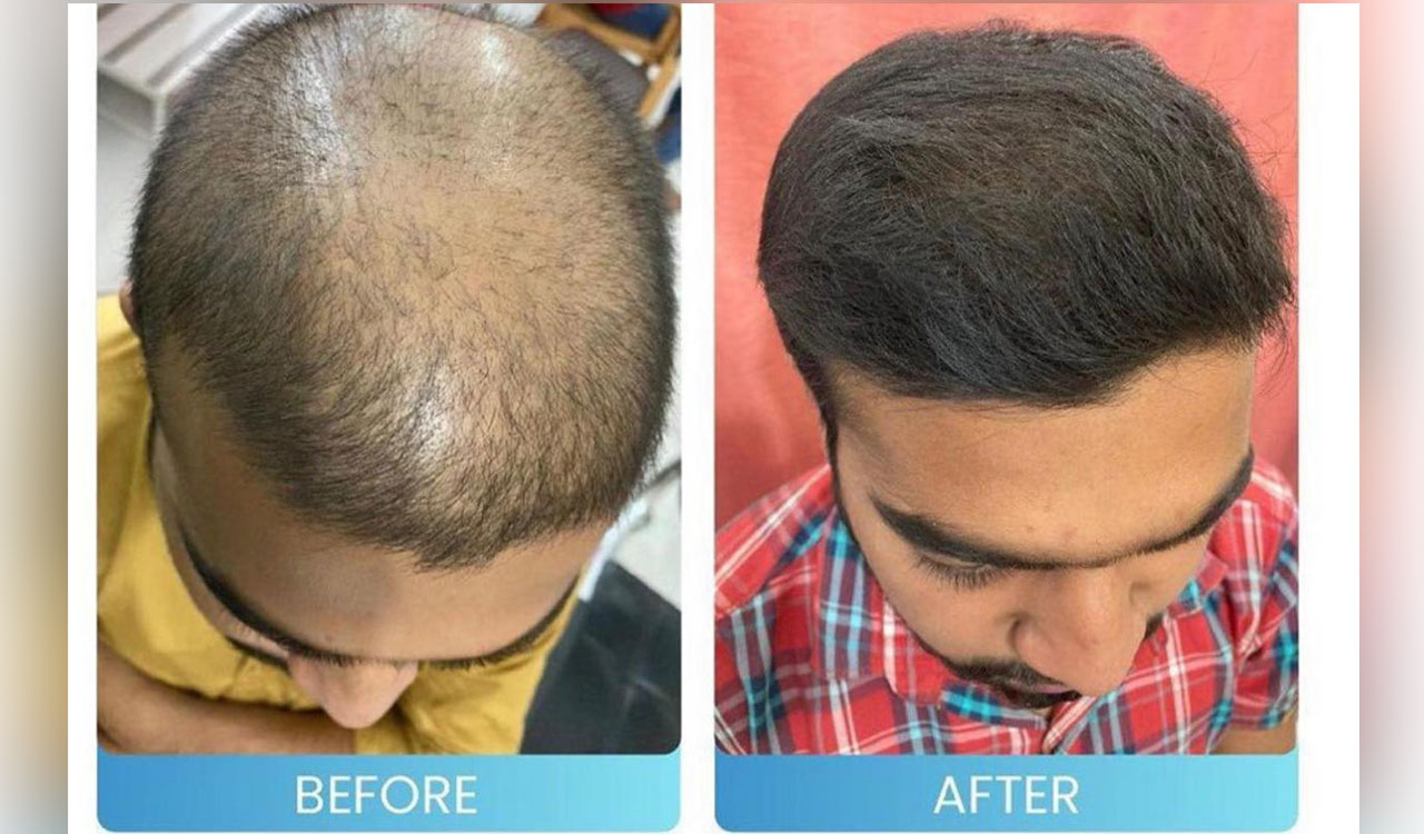 Reverse hair loss with Dr Stuti Khare Shukla’s FDA approved hair growth booster