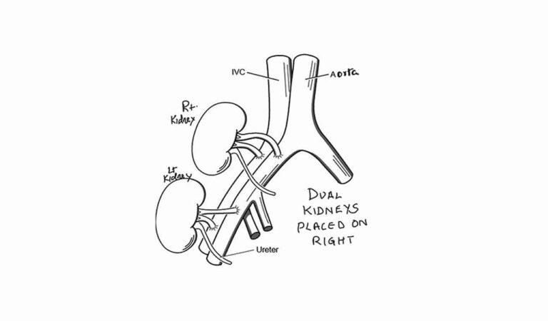 Dual Kidney